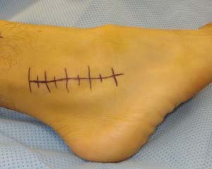 Ankle torsion20-pasclinic.ir
