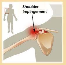 Shoulder strain syndrome-pasclinic.ir